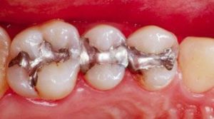 Biocompatible Dentistry in Honolulu - Dental Honolulu